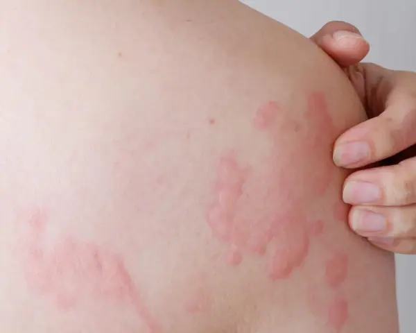 Pelle con pomfi rossi e pruriginosi, sintomo di orticaria solare. Una mano sfiora la zona colpita.