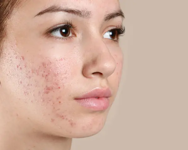 Primo piano del viso di una giovane donna con evidenti bollicine sul viso, segno di acne.