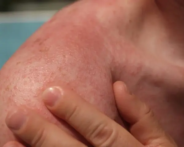 Spalla arrossata e irritata, con piccoli puntini rossi. Potrebbe essere necessario cercare rimedi eritema solare.