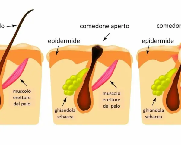 Illustrazione che spiega perchè escono i brufoli: un poro ostruito da sebo e cellule morte causa infiammazione.