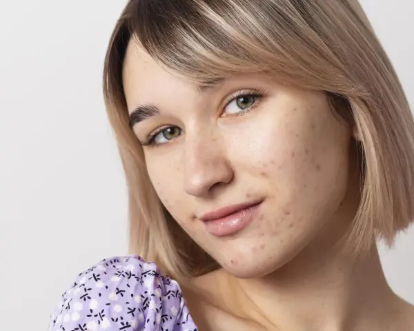 Primo piano di una giovane donna con pelle chiara e capelli biondi, che mostra segni di acne da sudore sul viso.