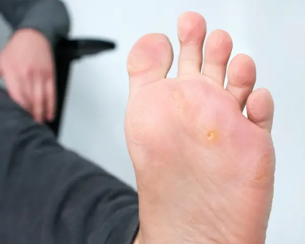 Primo piano di un piede con un occhio di pernice. Scopri come toglierlo facilmente.