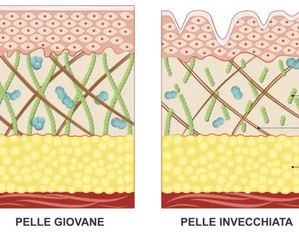 Confronto tra pelle giovane e pelle invecchiata: l'invecchiamento della pelle mostra riduzione di acido ialuronico, collagene, elastina e tessuto adiposo.