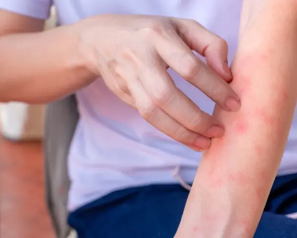 Mano che si gratta un braccio arrossato, con piccoli sfoghi che ricordano l'eczema sulle gambe.