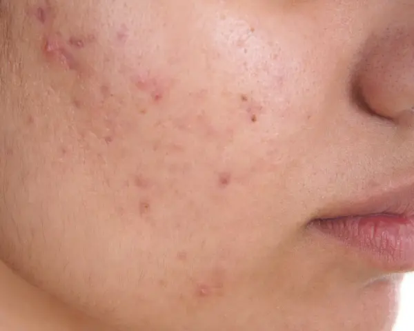 Primo piano di una guancia con diversi brufoli e pori dilatati, che evidenziano la texture della pelle.