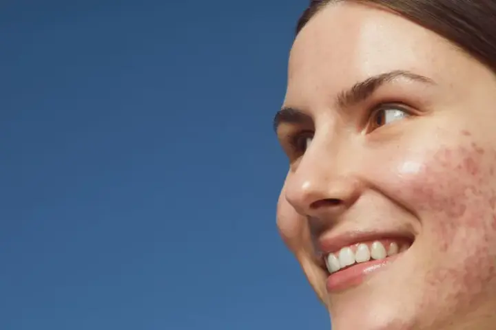 Primo piano di una giovane donna sorridente con pelle imperfetta, dove spicca un brufolo rosso.