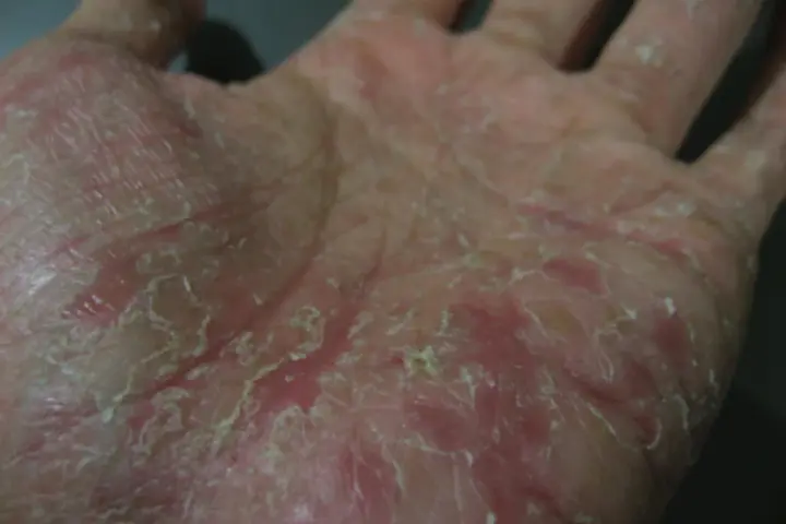 Mano con pelle secca, screpolata e arrossata, sintomo di disidrosi mani.