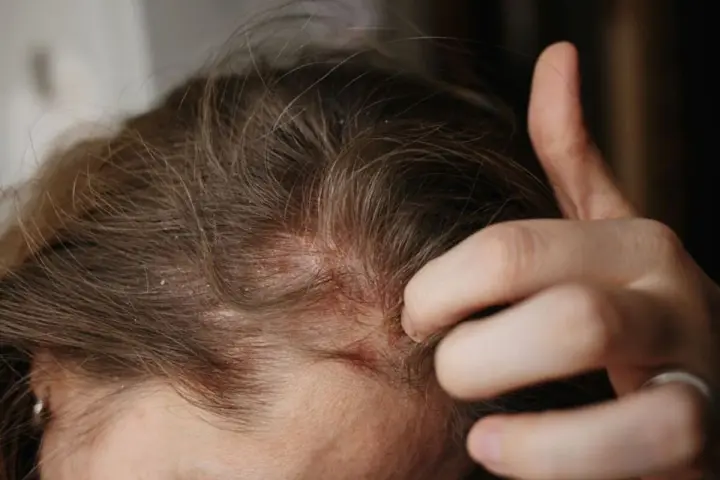 Dita che grattano un cuoio capelluto arrossato e dolorante, con evidenti squame bianche tra i capelli castani.