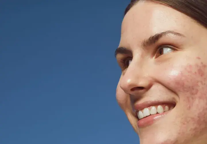 Primo piano di una giovane donna sorridente con pelle imperfetta, dove spicca un brufolo rosso.