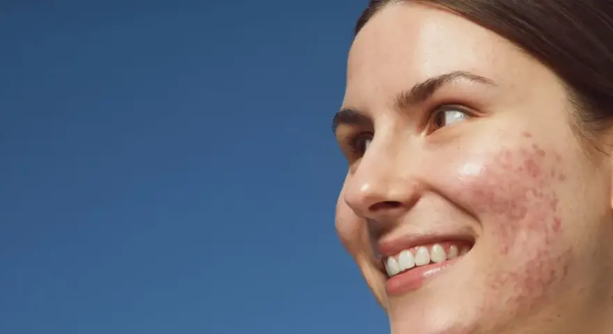 Primo piano di una giovane donna sorridente con pelle imperfetta, dove spicca un brufolo rosso.