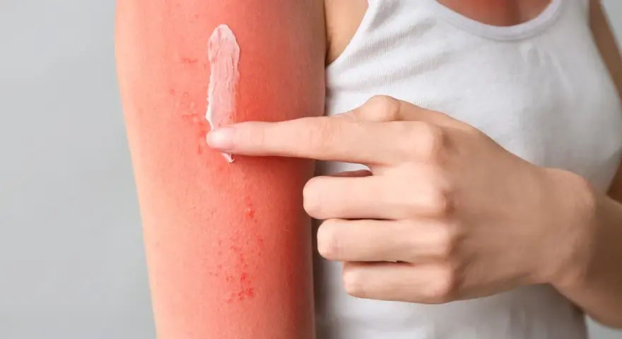 Mano applica crema su braccio arrossato dal sole, cercando rimedi per il prurito dopo abbronzatura.