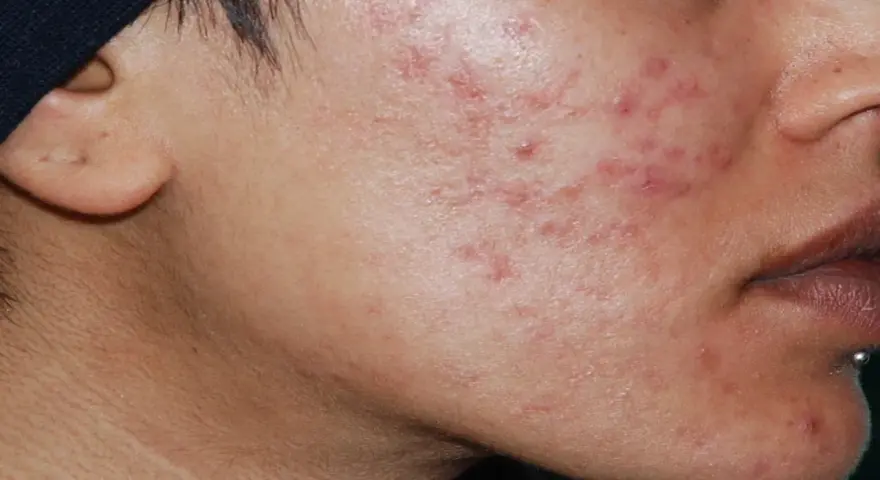 Primo piano del viso di un uomo con evidenti segni di acne ormonale maschile, arrossamenti e pustole sulla guancia e sul mento.