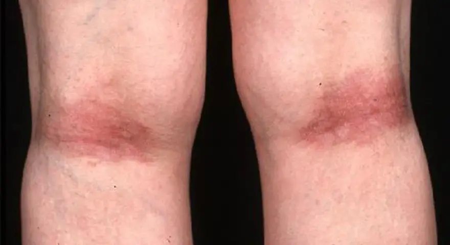 Gambe con arrossamento e ispessimento cutaneo, tipici della dermatite atopica.