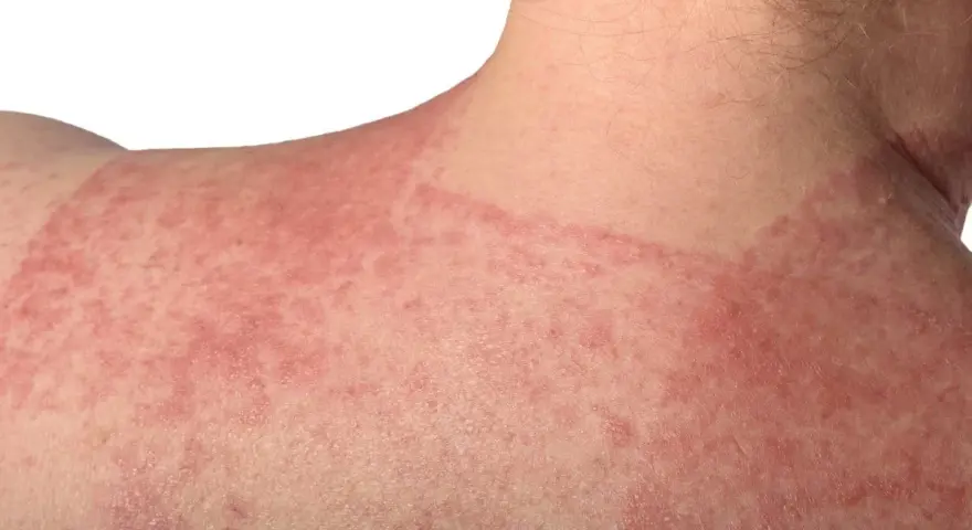 Estesa infiammazione della pelle con arrossamento e piccole pustole sul collo e sulla spalla.