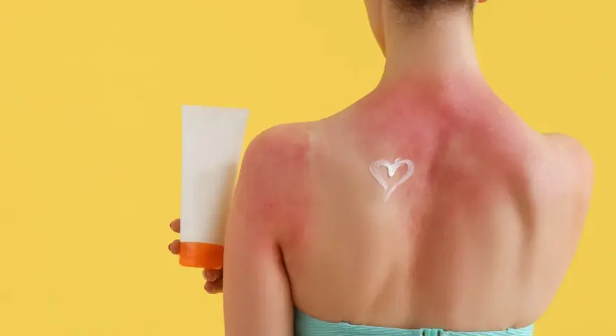 Schiena arrossata e dolente per una scottatura solare. Una crema solare a forma di cuore promette sollievo.