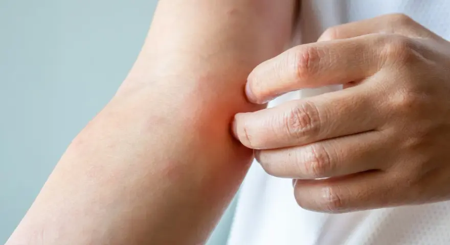 Mano che si gratta un braccio arrossato, possibile sintomo di prurito notturno cause.