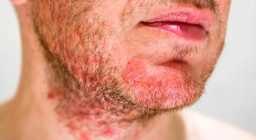 Primo piano di un uomo con dermatite viso, arrossamento e irritazione sulla barba e sul collo.