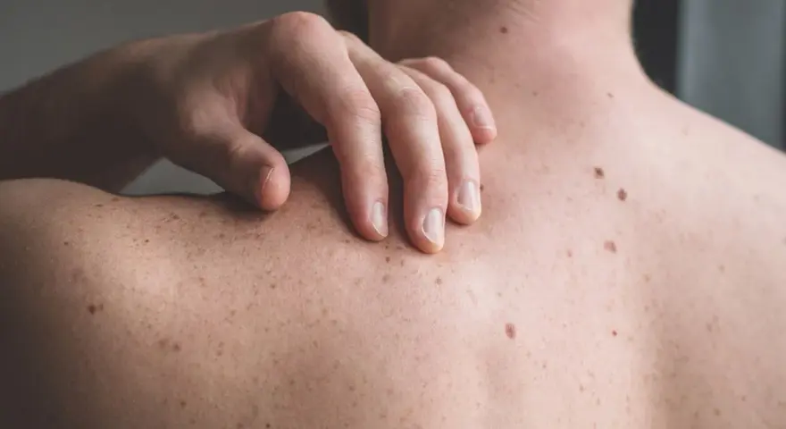 Mano che si gratta la schiena, coperta di nei. Un piccolo brufolo spunta su uno dei nei, un dettaglio inaspettato sulla pelle.