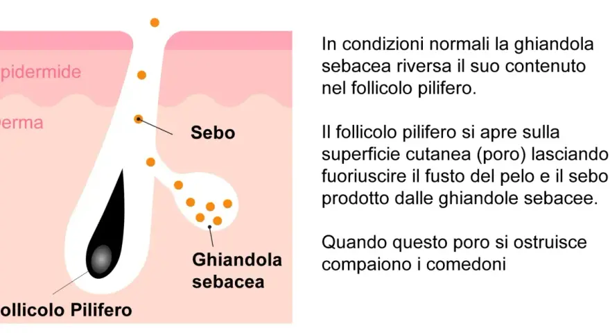 Illustrazione anatomica della pelle che spiega cosa sono i punti neri: il sebo ostruisce il follicolo pilifero.