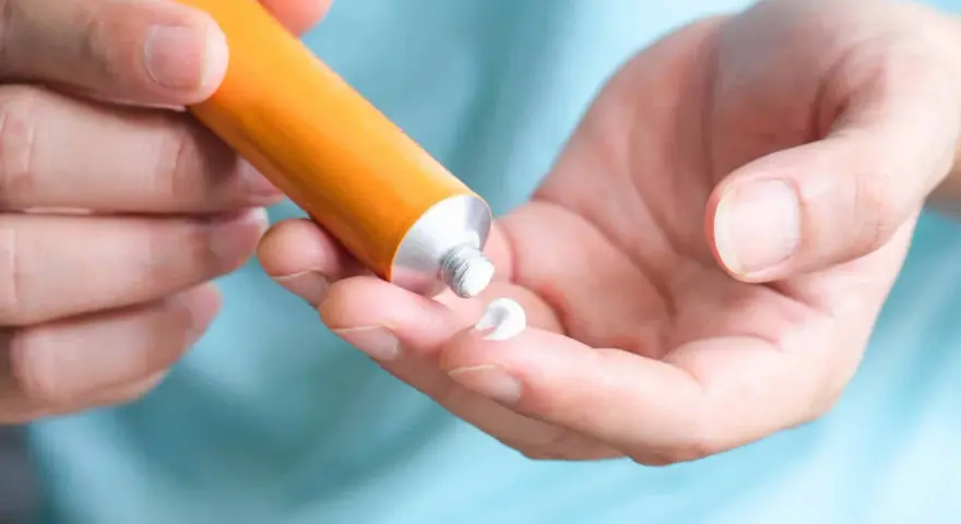 Mano che applica crema al cortisone su un dito, per alleviare la dermatite atopica.