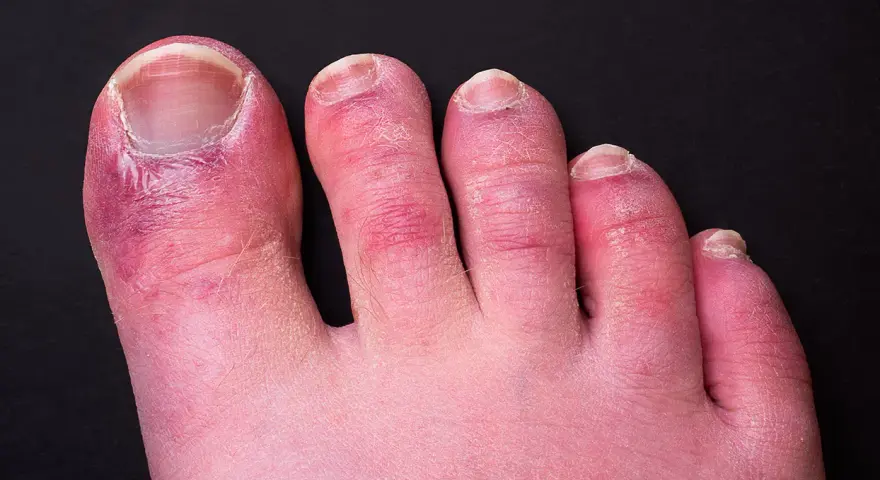 Dita dei piedi arrossate e gonfie, con segni di **geloni ai piedi**. La pelle appare secca e screpolata, soprattutto attorno alle unghie.