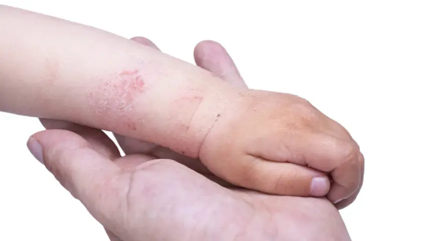 Braccio di bambino con chiazze rosse e squamose, sintomo di dermatite acuta, tenuto da una mano adulta.