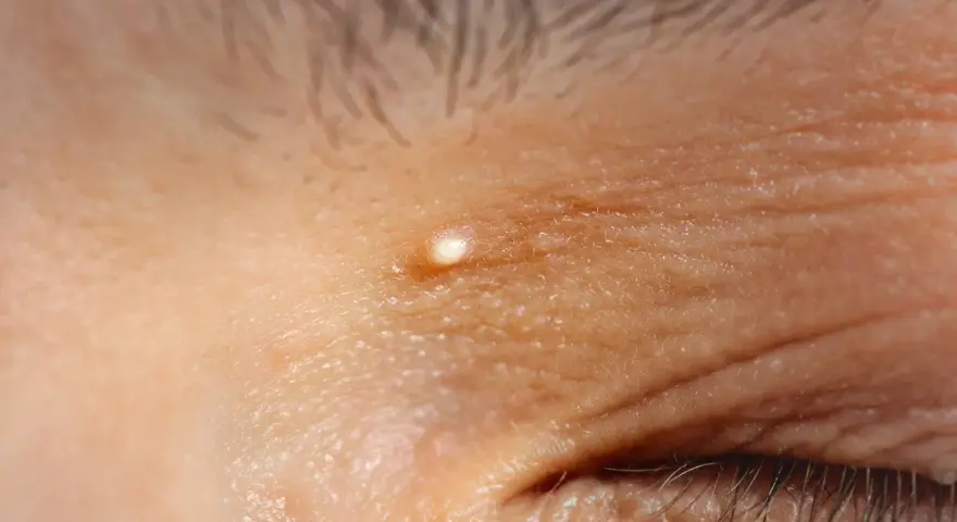 Un piccolo brufolo, simile a grani di miglio, appare sulla pelle rugosa vicino all'occhio.