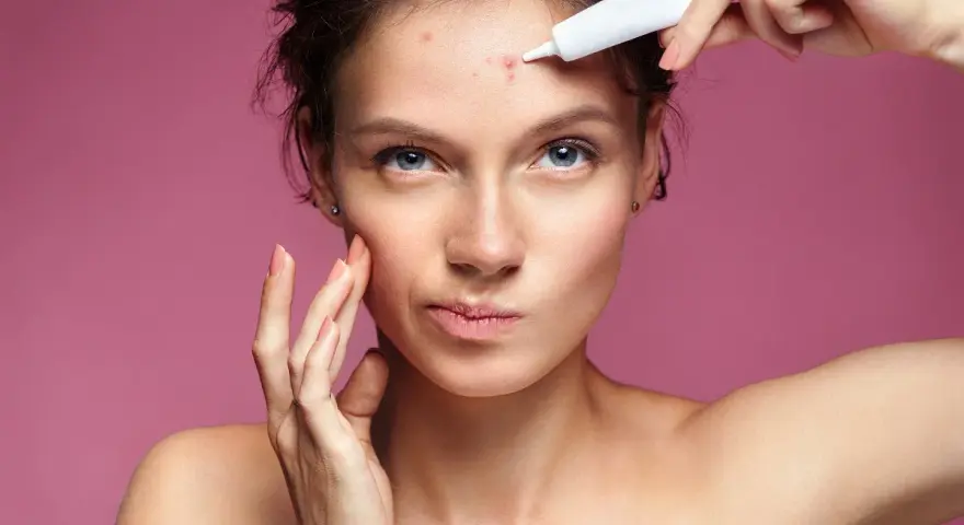 Donna applica crema su un brufolo sulla fronte, preoccupata di quanto dura un brufolo.