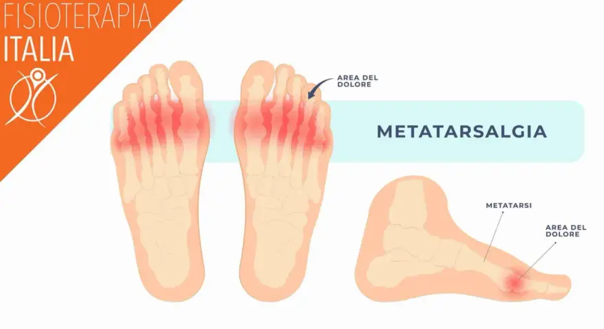 Illustrazione anatomica del piede che mostra la metatarsalgia, un dolore sotto le dita. Rimedi naturali per il dolore sotto le dita del piede.