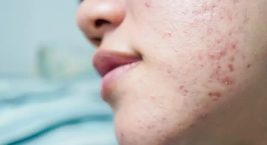 Primo piano del viso di una persona con brufoli pre ciclo, rossori e imperfezioni sulla guancia e sul mento.