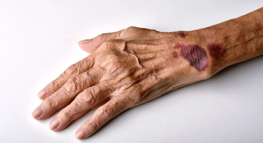 Mano anziana con evidenti segni di atrofia cutanea e lividi sul dorso, pelle sottile e rugosa.