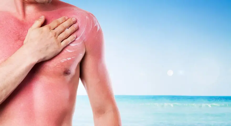 Uomo con forte eritema solare sul petto e spalla, mentre si applica una crema lenitiva. Il mare sullo sfondo ricorda l'estate.