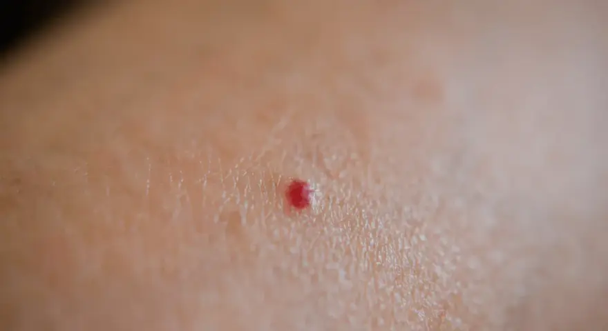 Piccola macchia rossa sulla pelle, tipo bruciatura, che prude.