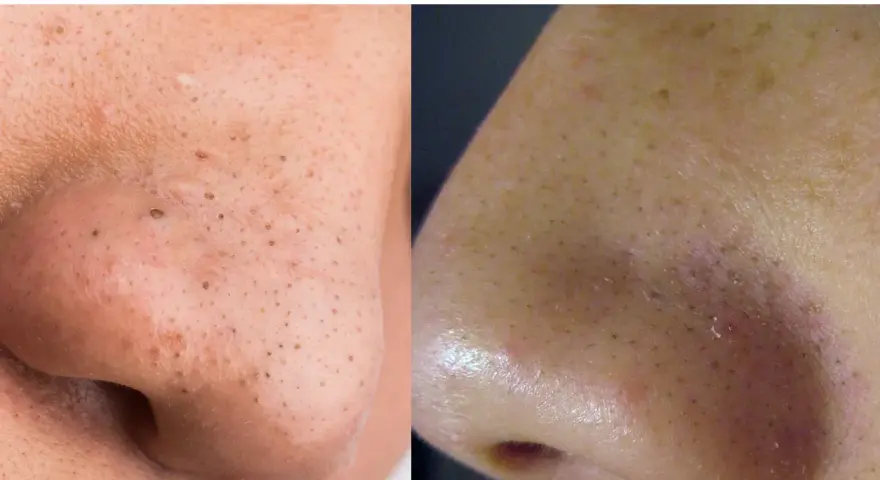 Confronto tra punti neri e filamenti sebacei sul naso. I filamenti sebacei appaiono come piccoli puntini chiari, mentre i punti neri sono più scuri e visibili.