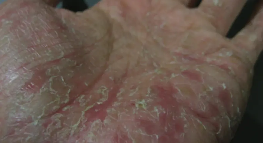 Mano con pelle secca, screpolata e arrossata, sintomo di disidrosi mani.