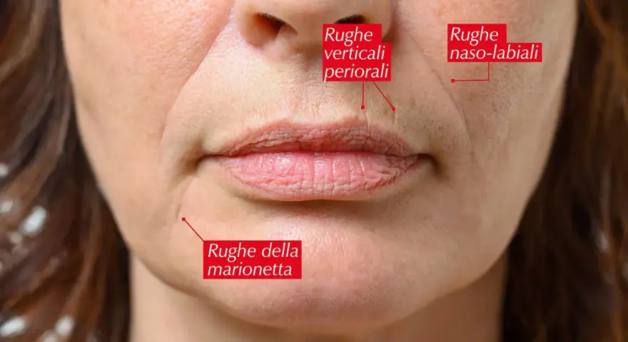 Primo piano del volto di una donna che mostra cosa sono le rughe: naso-labiali, verticali periorali e della marionetta.
