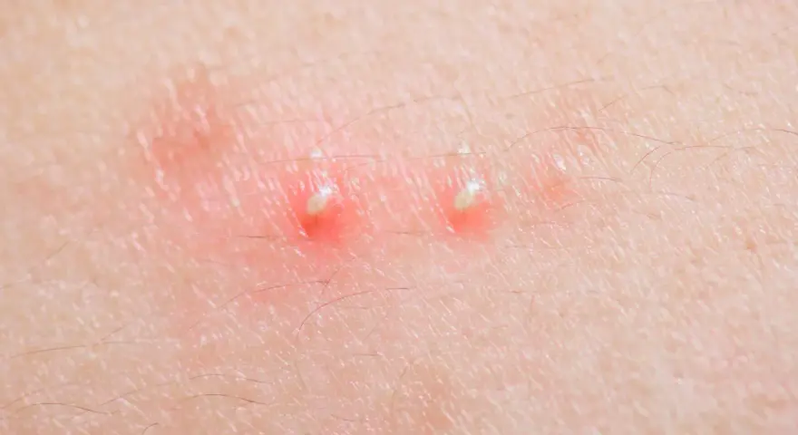 Due pustole sul corpo, rosse e gonfie, con la punta bianca, circondate da peluria sottile.