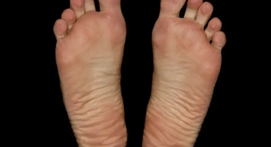 Piante dei piedi con evidenti calli e rughe, segno di lunghe camminate.