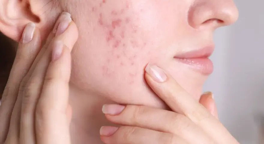Primo piano del viso di una donna con brufoli sul viso, che si tocca la guancia. Capire perchè vengono i brufoli è il primo passo per una pelle sana.