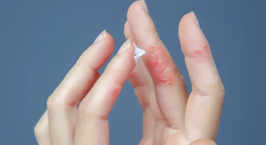 Mani con dermatite dita: pelle arrossata, screpolata e con piccole lesioni. Una mano applica crema.