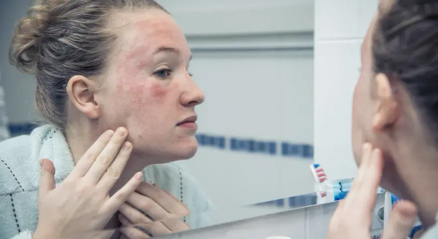 Donna con viso arrossato e irritato si guarda allo specchio, preoccupata che la glicerina viso fa male.