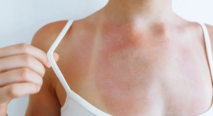 Spalla arrossata e irritata, con segni evidenti di eritema solare prurito. La pelle è segnata dal sole.