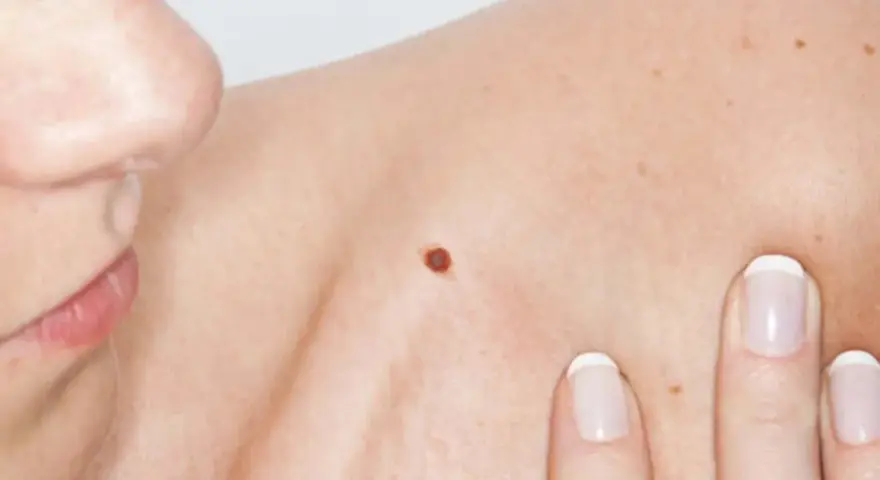 Primo piano di una spalla con un neo rosso sulla pelle. Dita con unghie curate sfiorano delicatamente la cute.