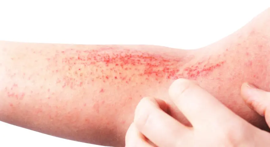 Braccio con eruzione cutanea rossa e puntini, possibile micosi dermatite da stress senza prurito.