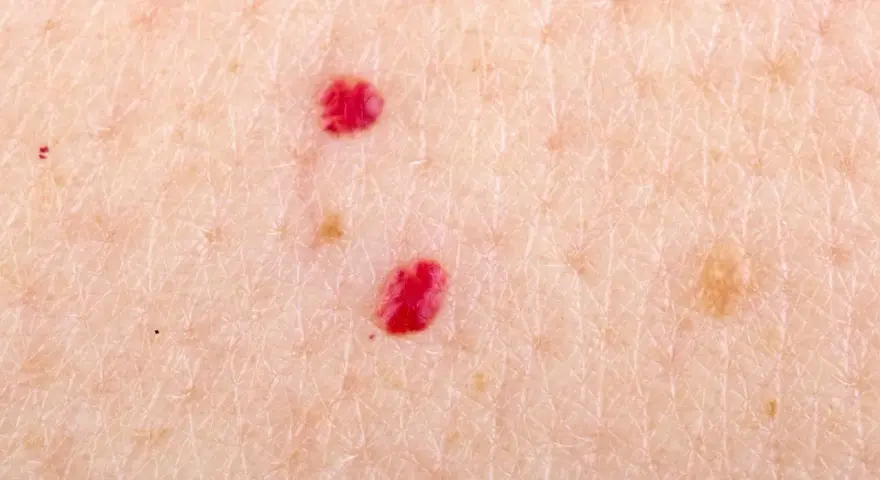 Primo piano della pelle con due angiomi rubino. Si cercano angioma rubino rimedi naturali per attenuare queste piccole macchie rosse.