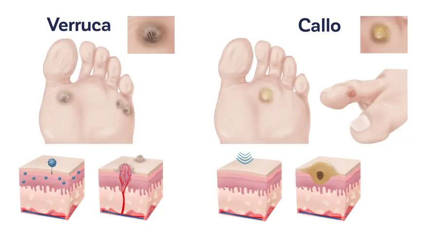 Illustrazione comparativa di verruche e calli, mostrando i diversi tipi e le loro caratteristiche cutanee.