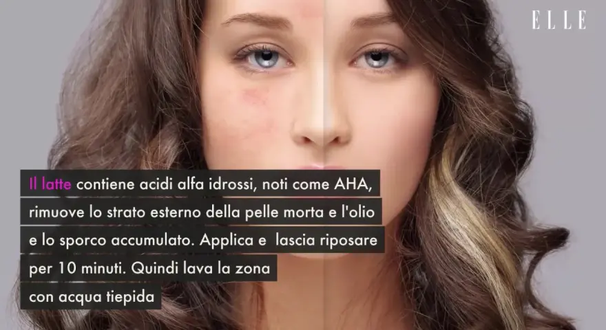 Scopri come togliere i brufoli dal viso con il latte, ricco di AHA che esfoliano e puliscono la pelle.