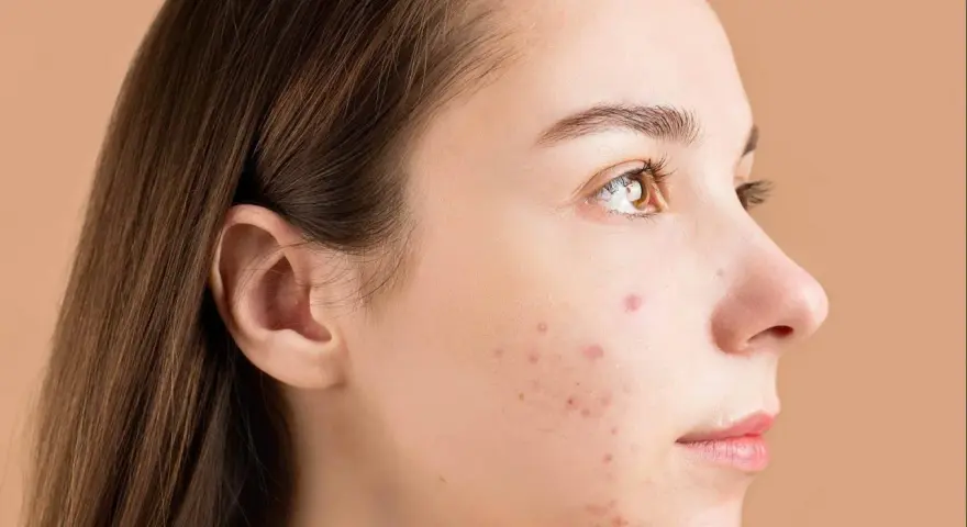 Primo piano del viso di una giovane donna con brufoli. La domanda "quanto ci mette un brufolo ad andare via" è centrale per chi soffre di acne.