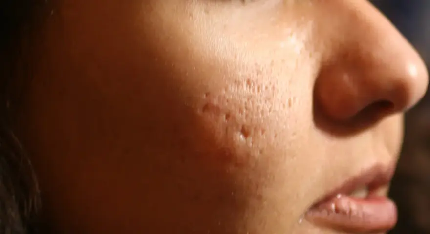 Primo piano del viso di una persona con evidenti cicatrici da acne, simili a macchie varicella, sulla guancia.