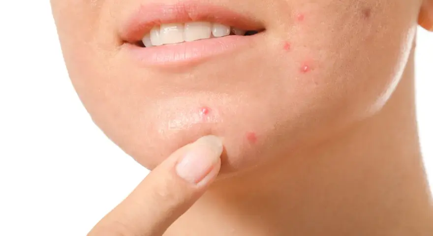 Dito, come non schiacciare i brufoli: un dito indica un brufolo sul viso, vicino alla bocca.